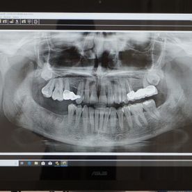 Clínica Dental Eva María Millan Prado pantalla con radiografía 